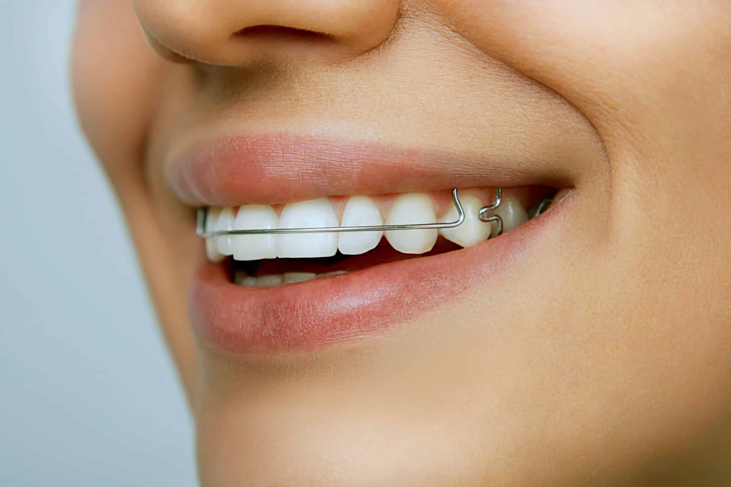close-up of a smiling woman with braces