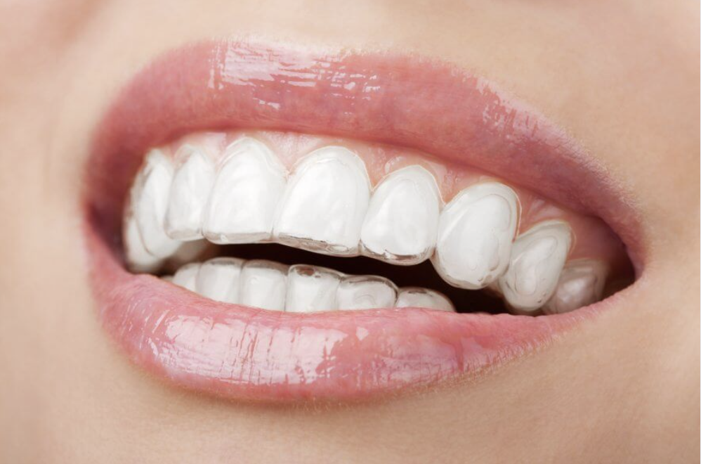 Close up of an Invisalign clear aligner being held by a smiling woman on a sunny day