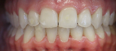 a class iii malocclusion surgical case after