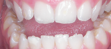 a class iii malocclusion surgical case before